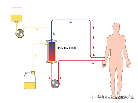 exchange,pe 是指将身体中血液引出体外,将血浆从全血中分离出来后