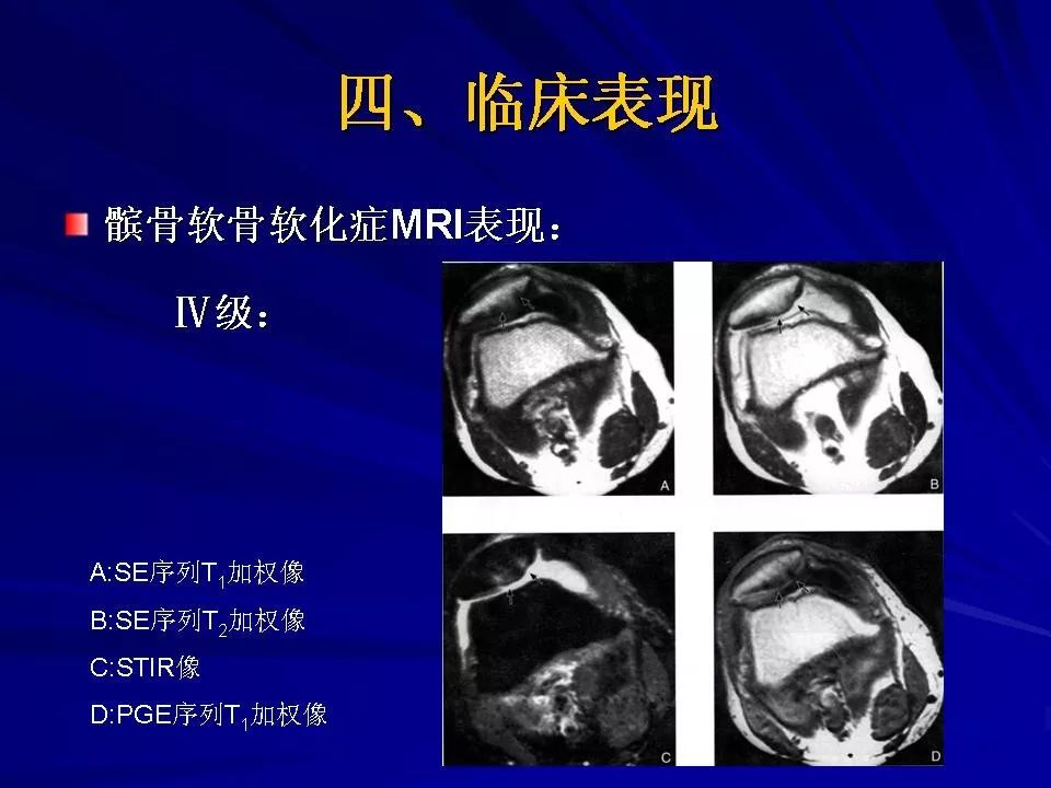 髌骨软化症的诊断及治疗影像天地