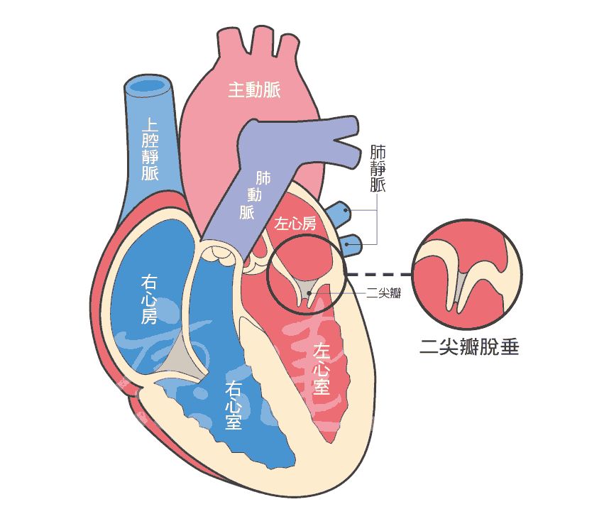 二尖瓣脱垂到底是什么病如何正确治疗看完你就懂了