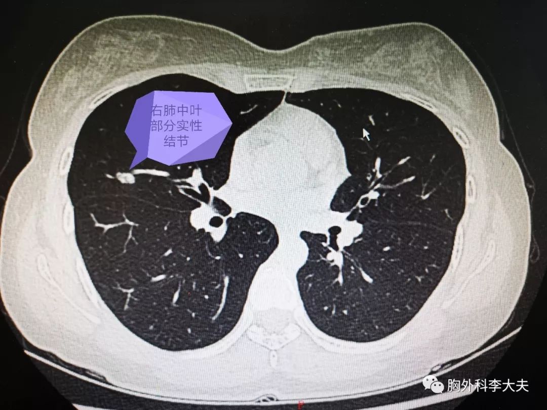 正常肺ct平扫示意图,正常胃t平扫示意图,正常胃t示意图_大山谷图库