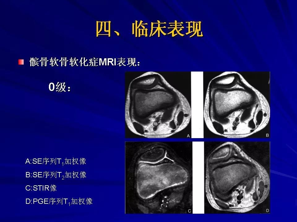 髌骨软化症的诊断及治疗影像天地