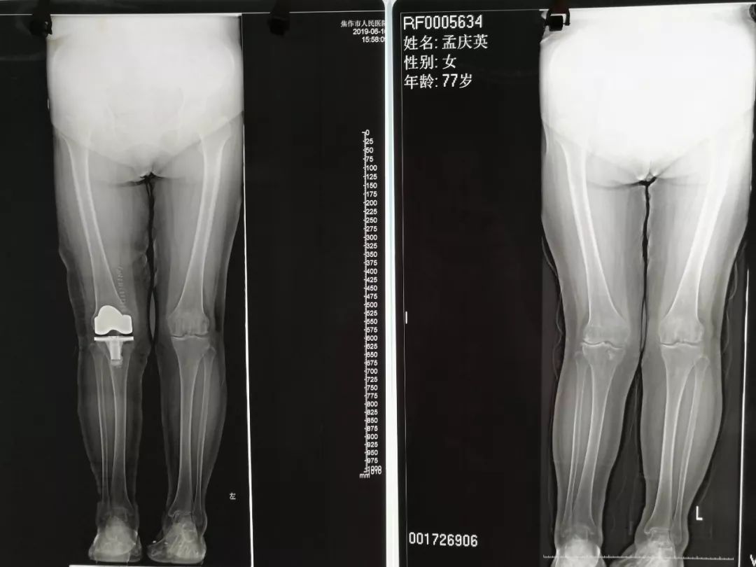 关节外科成功施行“严重膝外翻人工膝关节置换术”_手机搜狐网