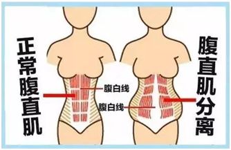 【围产保健】怀孕撑"破"肚皮,腹直肌分离惹的祸