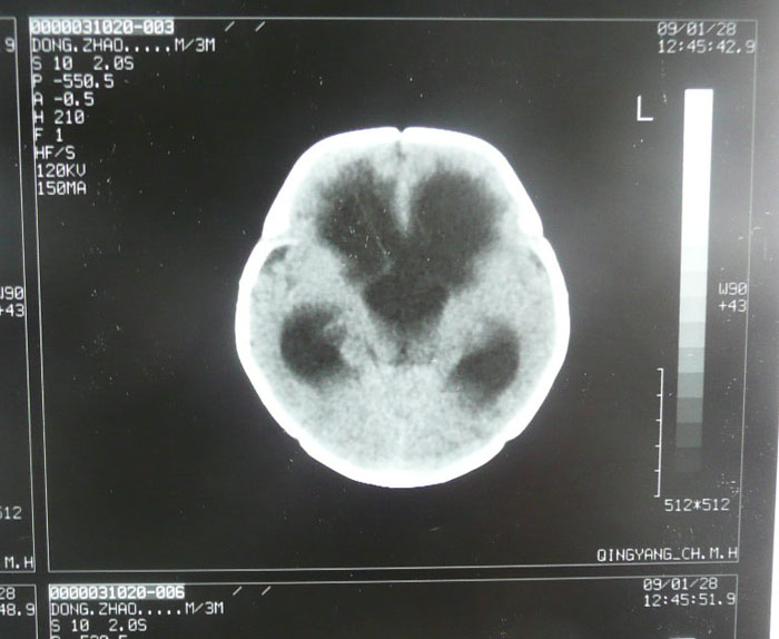 贺晓生教授双侧脑积水治疗案例