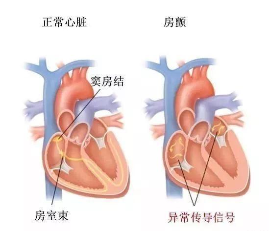 房颤时患者会感到:胸部疼痛,压迫或者不舒服;心脏跳动紊乱或心跳加快