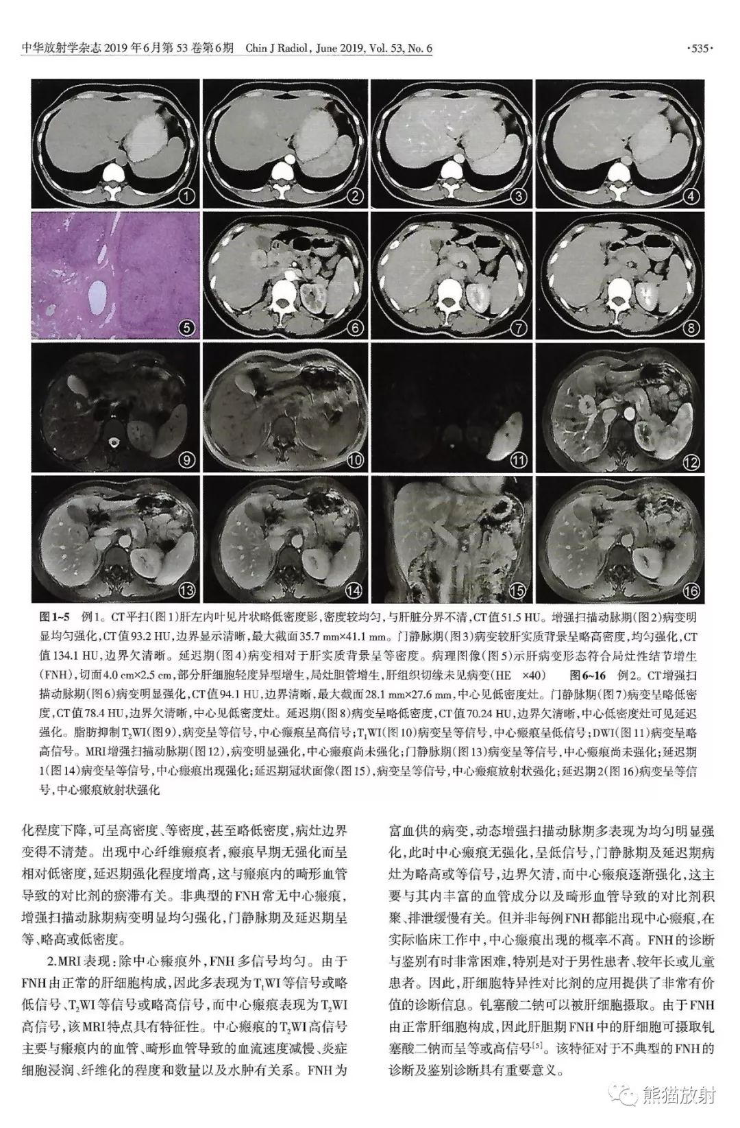 肝脏局灶性结节增生丨ct及mri诊断及鉴别诊断要点