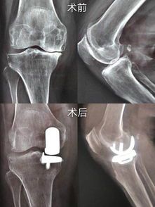 膝盖骨关节炎怎么办