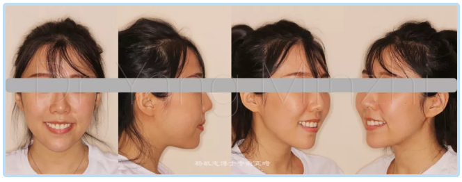 牙齿矫正会让牙齿松动?拔牙矫正有后遗症?听听正畸医生怎么说