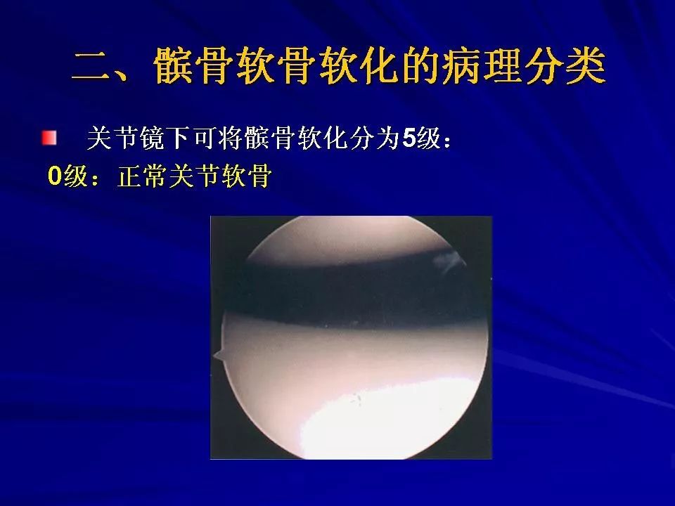 髌骨软化症的诊断及治疗影像天地