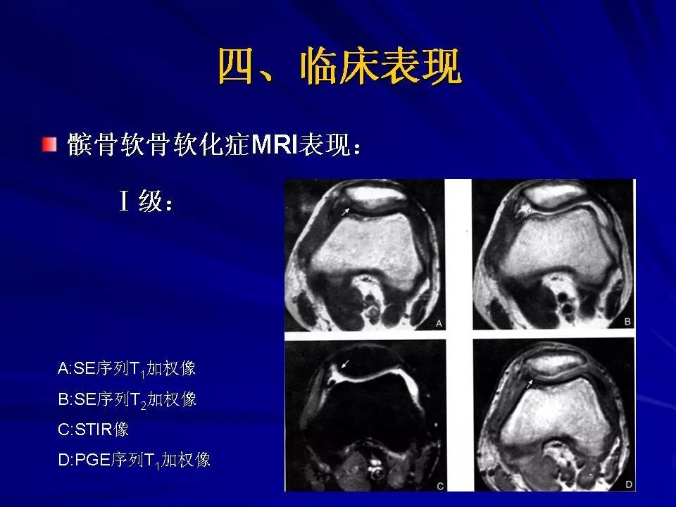 髌骨软化症的诊断及治疗影像天地