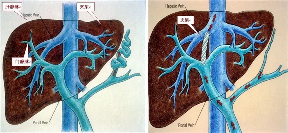 在肝静脉或下腔静脉肝段与门静脉分支间建立门-体分流的人工通道