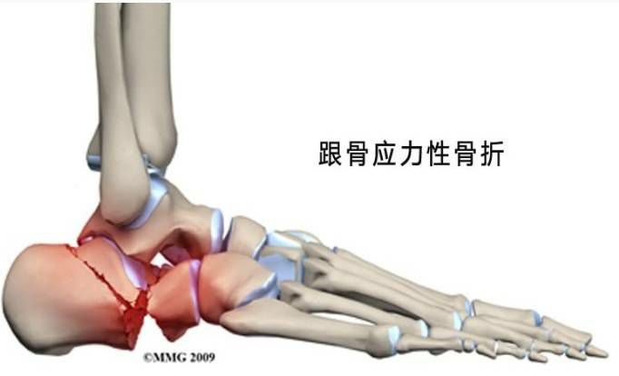 「星·健文」跑步给跑骨折了是神马情况?让我们一探应力性骨折!