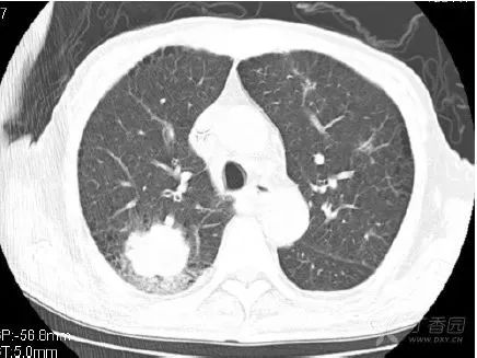 影像入门必备:6 种最常见的胸部 ct 征象