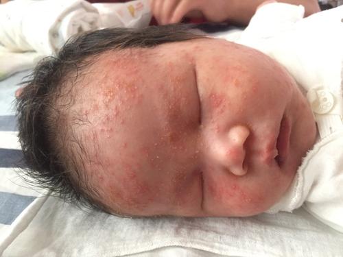                     炎炎夏日，这4种皮肤病最容易找上宝宝，爸妈多长个心眼！