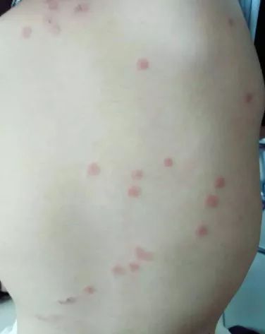 3岁女童浑身红疹，起因是这个每家都有的东西！夏天更要注意|小女孩为什么会起红疹