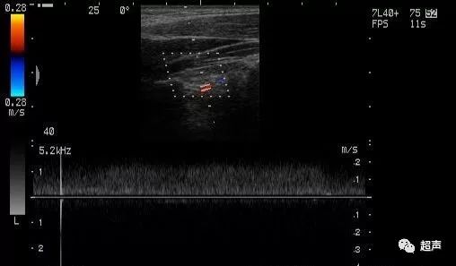 超声微课堂频谱多普勒基础