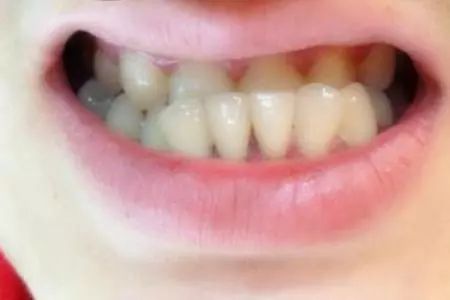 如果孩子乳牙出来就有地包天(反颌),大概3-4岁的时候就可以进行治疗.