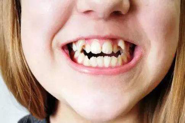 儿童牙齿畸形怎么办 如何预防儿童牙齿畸形