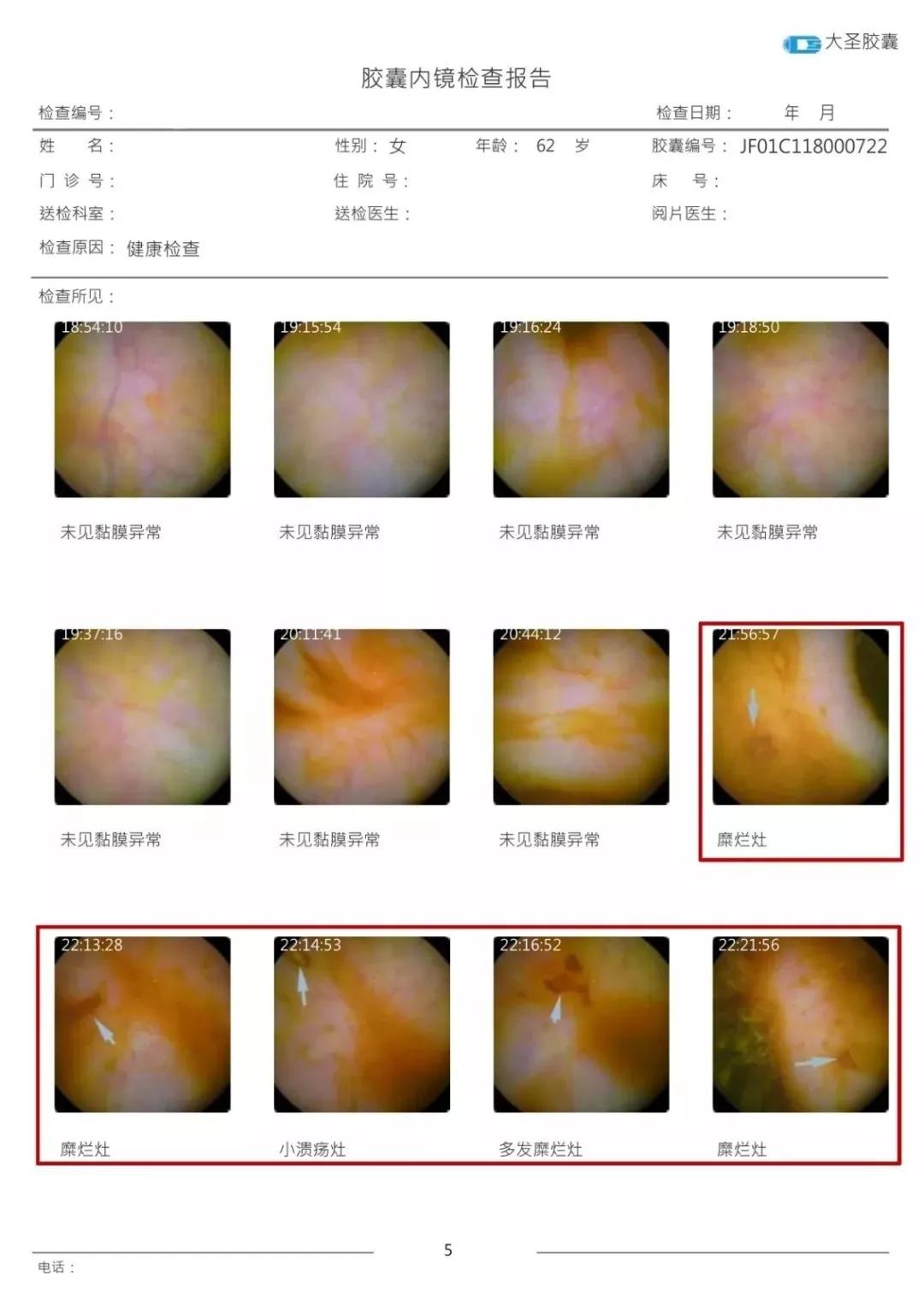 害怕做胃肠镜绥化肿瘤医院引进大圣胶囊内镜让胃肠检查更轻松