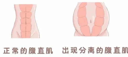 【医学科普】不做"小腹婆",腹直肌康复训练还要注意这些