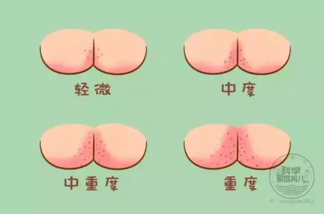                     原创            几乎所有娃都会长的5大疹子！与其乱擦药不如做好这2件事