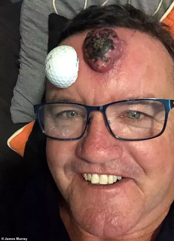 恐怖| 澳洲男子额头长"痘痘"用手挤,6周后变成致命癌症肿块!