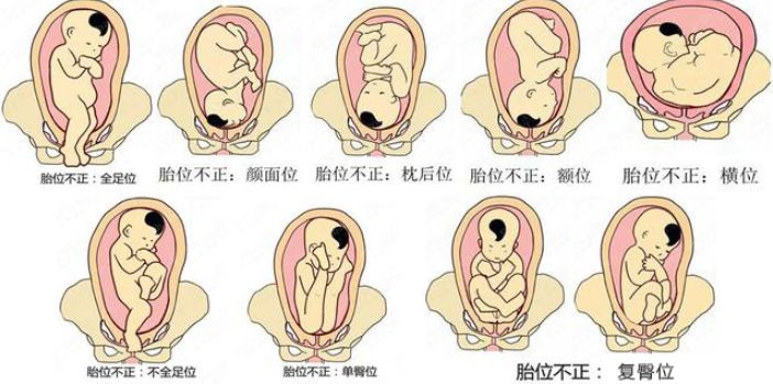 妊娠30周后经产前检查,发现臀位,横位,枕后位,颜面位等谓之胎位不正