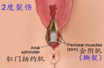 10个顺产9个侧切？孕期做好这些，宝妈可以少挨刀！