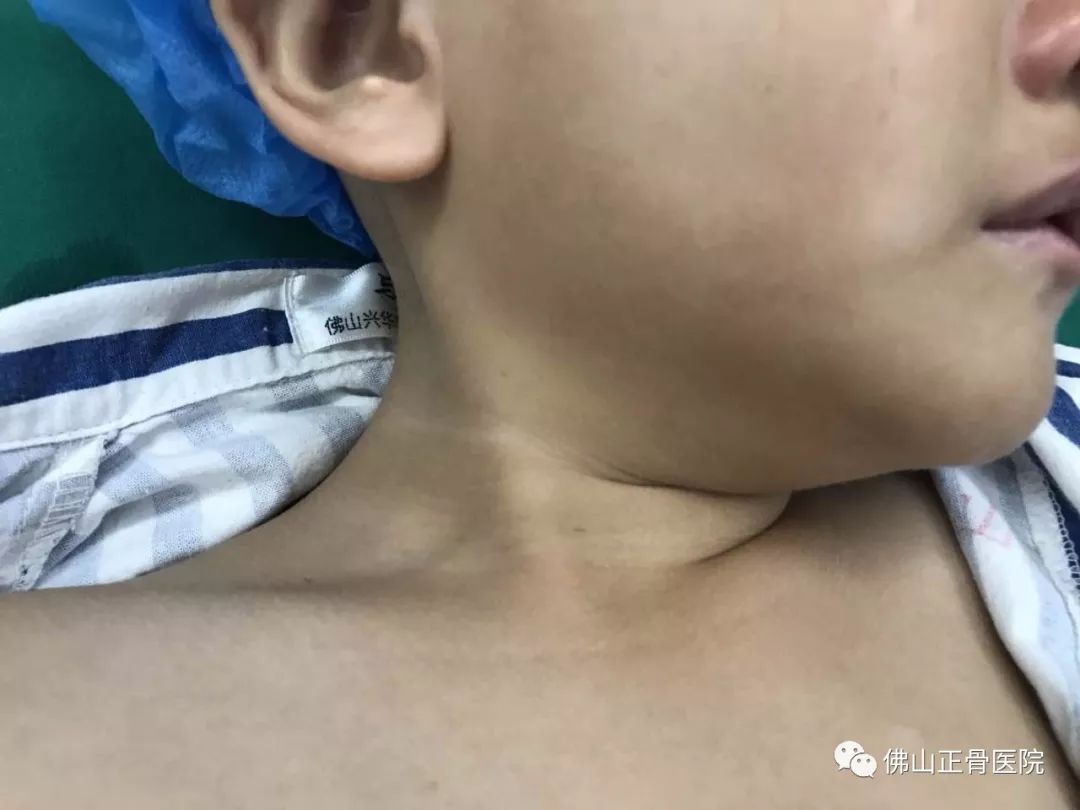 微刀专利技术松解5岁女童肌性斜颈,刀口只有芝麻大小