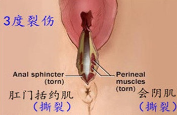 10个顺产9个侧切？孕期做好这些，宝妈可以少挨刀！