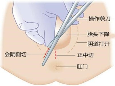 10个顺产9个侧切？孕期做好这些，宝妈可以少挨刀！