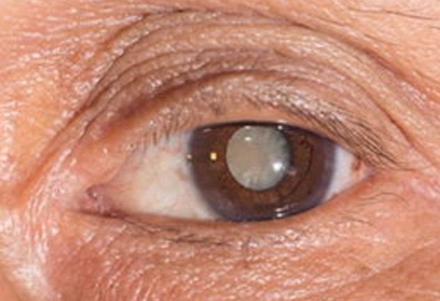 最后,随着年龄的增长,晶状体开始退化,会出现白内障,老花等眼部疾病