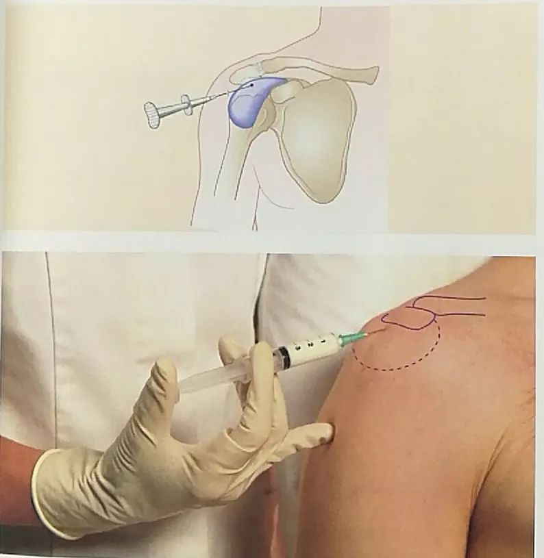 或肩部的前方·可引起疼痛的动作:内旋抗阻主动外展器具和药物注射器