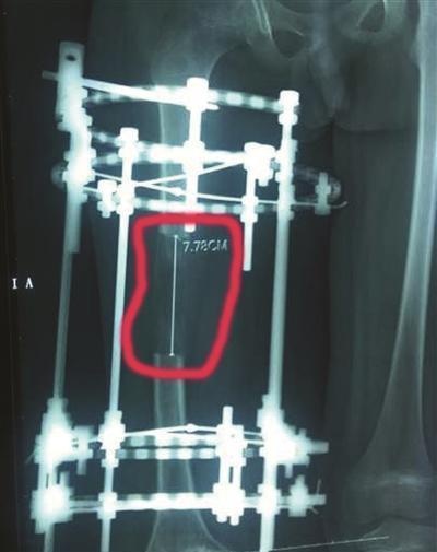                     原创            4岁男童两腿长短不一，10岁时竟靠“断骨增高”治好了？