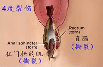 10个顺产9个侧切？孕期做好这些，宝妈可以少挨刀！