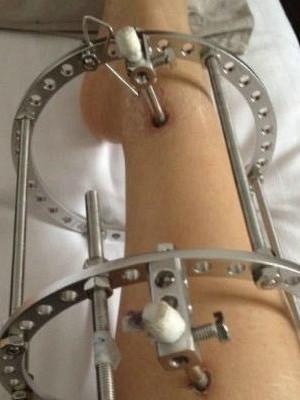                     原创            4岁男童两腿长短不一，10岁时竟靠“断骨增高”治好了？