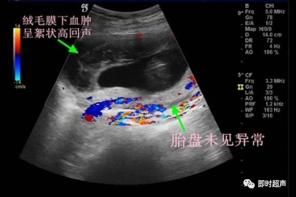 绒毛膜下血肿超声表现