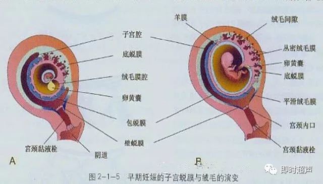 绒毛膜下血肿超声表现