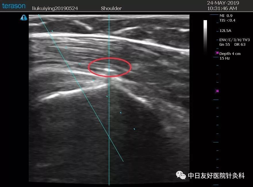 病例分享超声引导下针刀治疗肩袖钙化性肌腱炎一例