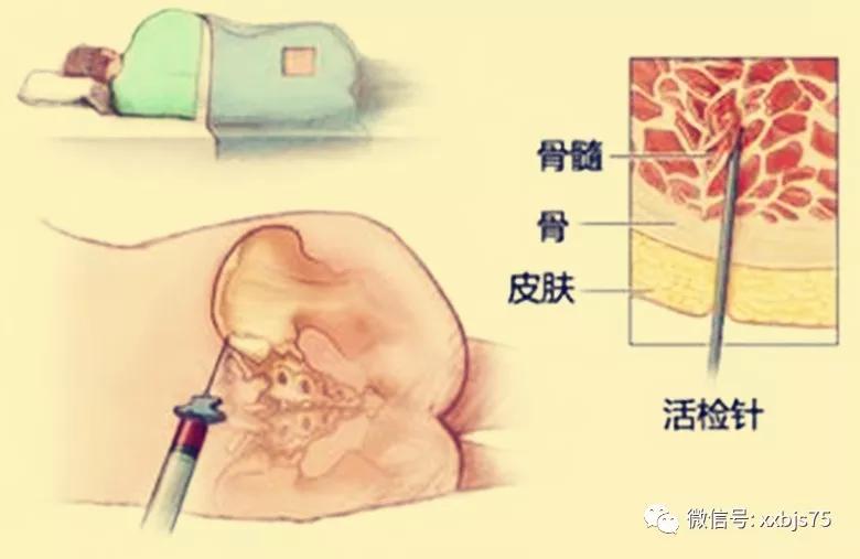 初诊血小板减少有必要做骨髓穿刺检查吗附激素减量问题