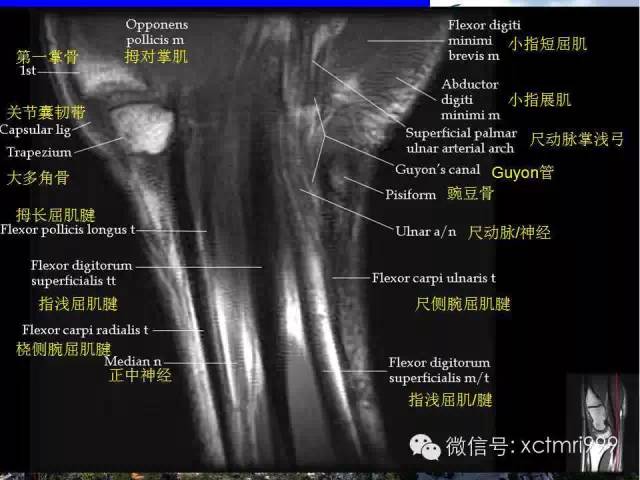 推荐| 腕关节mr解剖中英对照