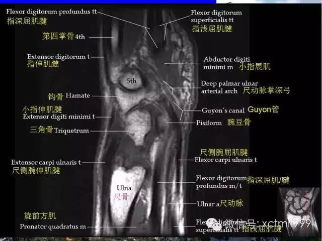 推荐| 腕关节mr解剖中英对照