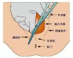 女人顺产时，“撕裂”和“侧切”会影响夫妻生活吗？医生给出答案