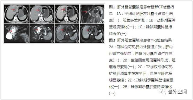 肝外胆管囊腺瘤的诊断与治疗一