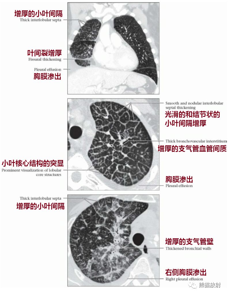 癌性淋巴管炎