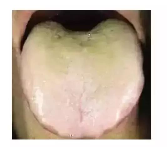 怎么看舌苔