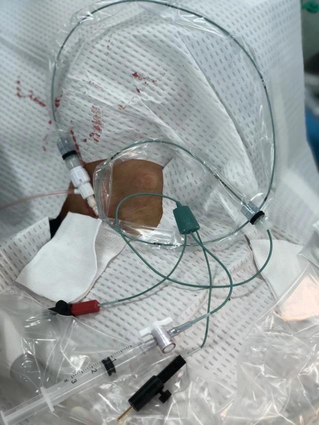 球囊漂浮电极心脏临时起搏器成功应用于严重缓慢型心律失常手术患者