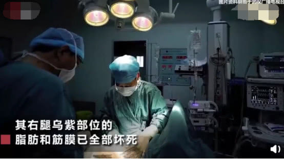                     原创            4岁女童被蚊虫叮咬，破皮部位脂肪和筋膜已经全部坏死