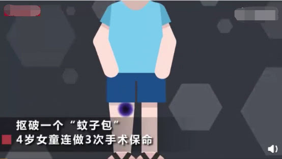                     原创            4岁女童被蚊虫叮咬，破皮部位脂肪和筋膜已经全部坏死