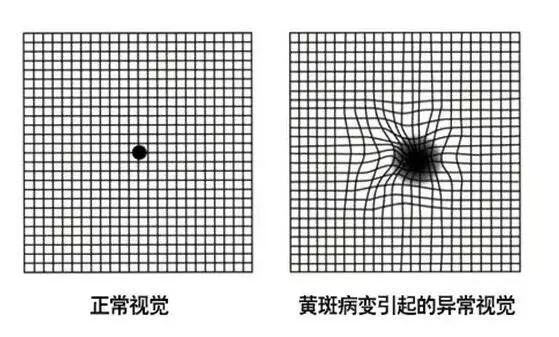 视物变形,对比敏感度下降(视野整体不鲜明)以及有视野中心暗点